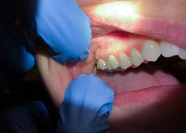 Best Emergency Treatment for Toothache in Lake Placid, NY
