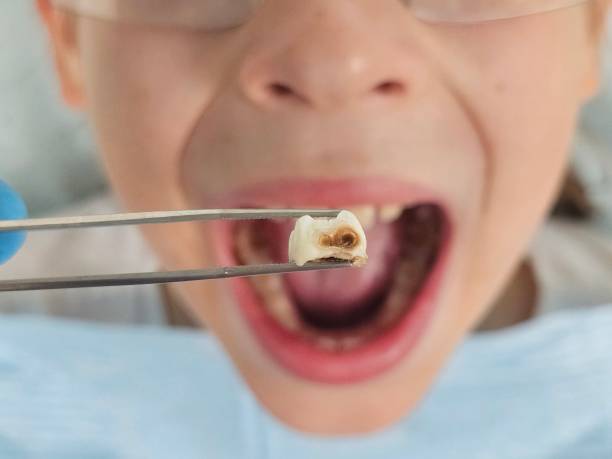 Best Emergency Broken Tooth Repair in Lake Placid, NY